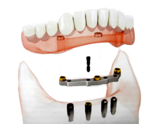 sustitución de todos los dientes mediante prótesis removibles implantosoportadas
