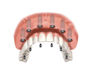 sustitución de todos los dientes mediante prótesis fijas sobre implantes